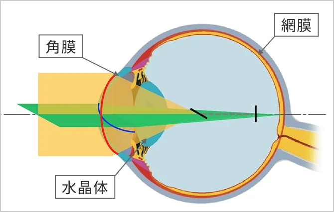 乱視とは