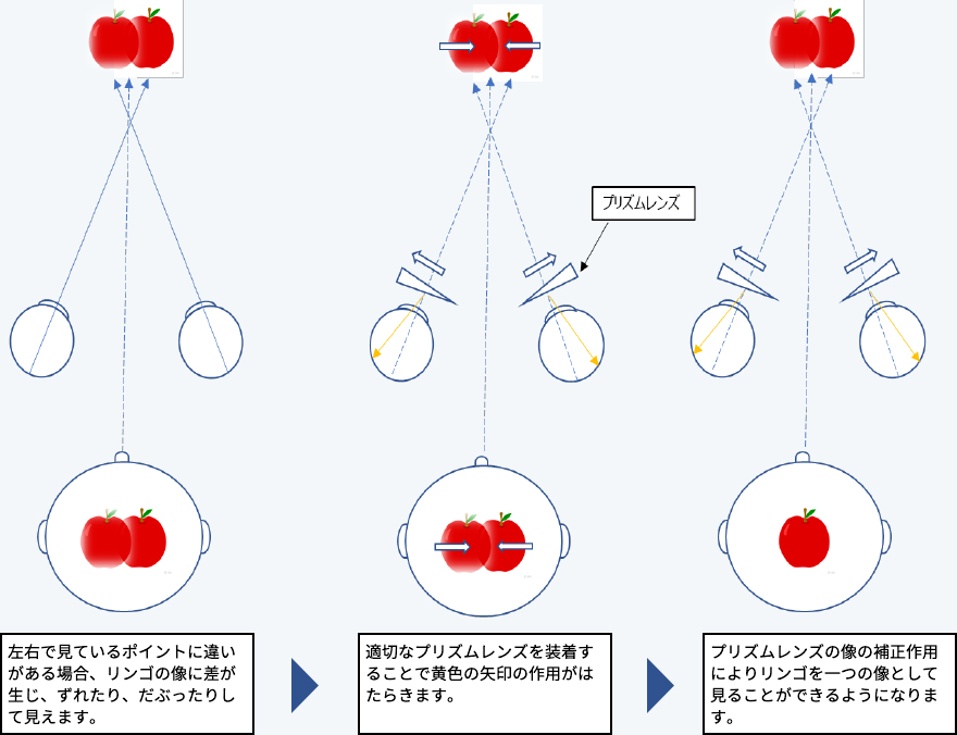 両眼での見え方のバランスを最終調整する『両眼立体サポートレンズ』