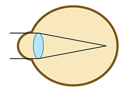 近視の図