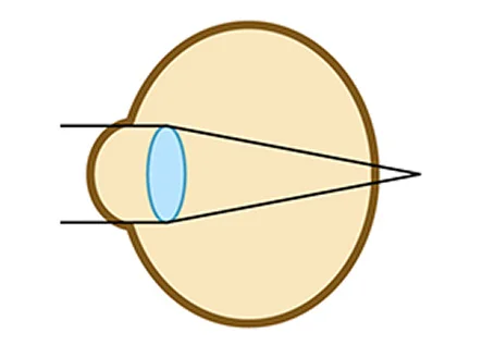 遠視の図